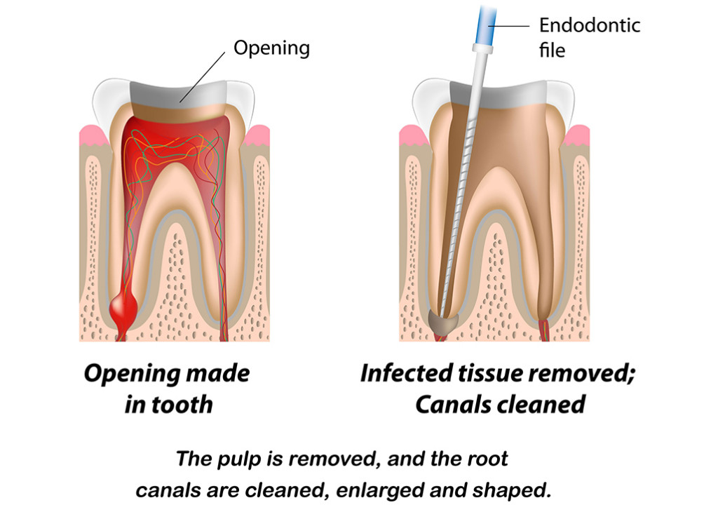 Root-Canal_Treat_Diagram