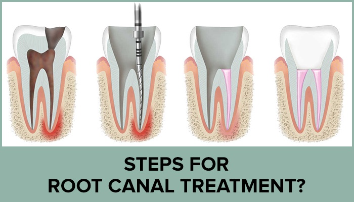 The stages of root canal treatment