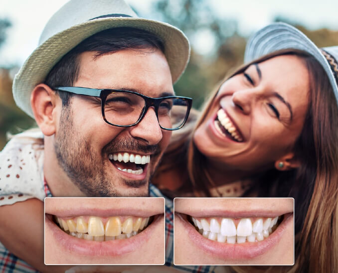 Boutique Whitening professional teeth whitening system