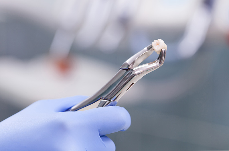 Tooth extraction procedure