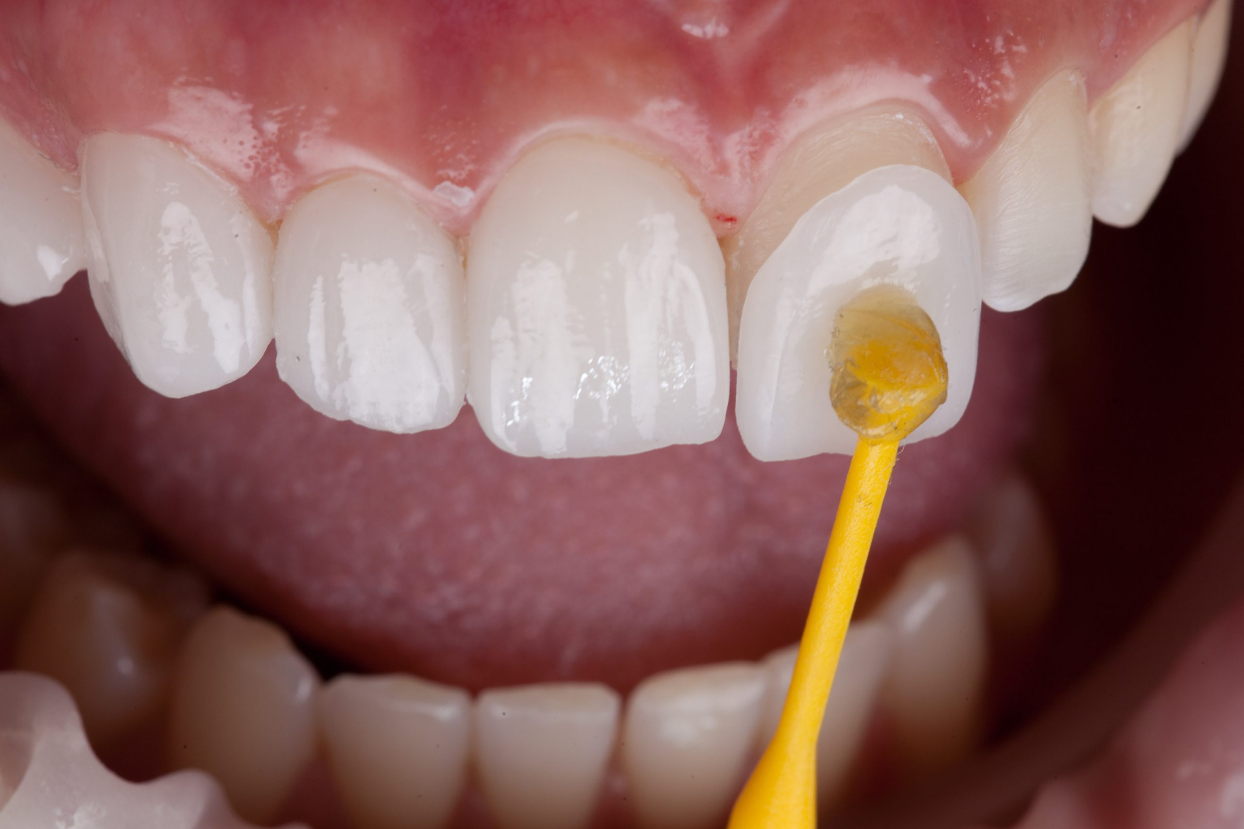 Dental veneer close up